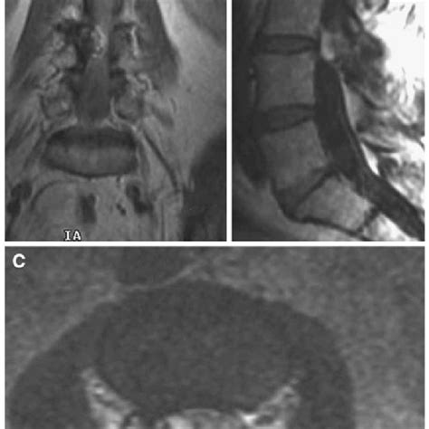 Pdf Spontaneous Hemorrhage Into A Lumbar Synovial Cyst