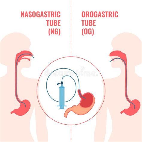 Nasogastric And Orogastric Feeding Tubes Medical Diagram Stock Vector