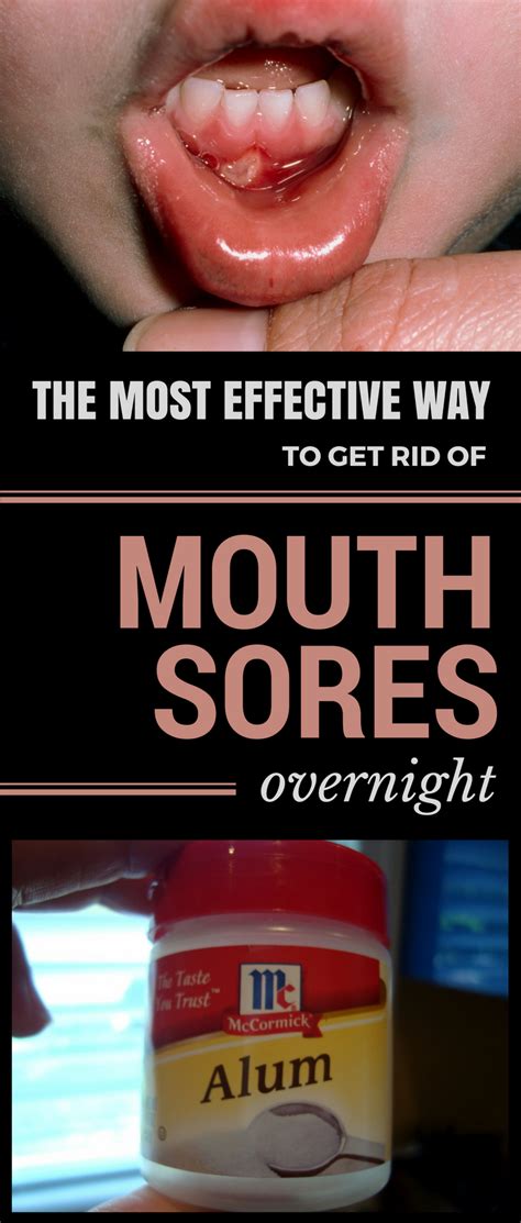 The Most Effective Way To Get Rid Of Mouth Sores Overnight Mouth