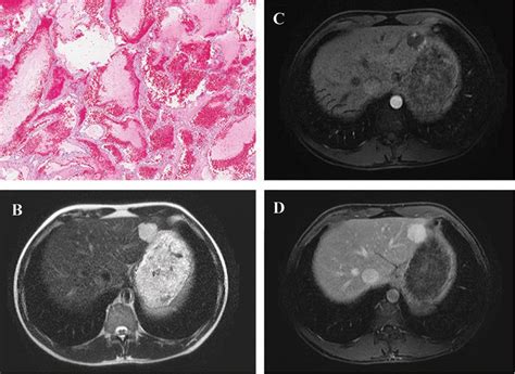 Hepatobiliary Tumors Update On Diagnosis And Management