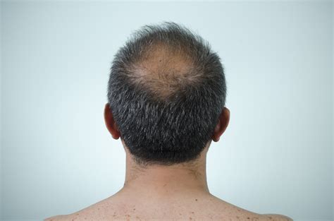The Back View Of A Mans Head Who Is Balding Dermatology Associates