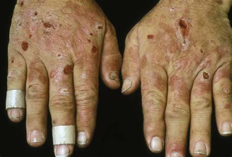 Dermatologic Signs Of Systemic Disease