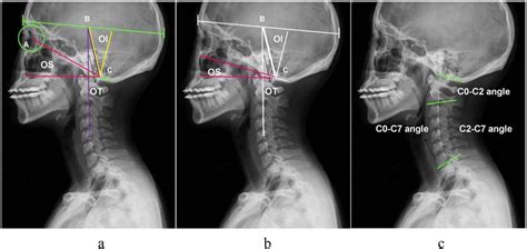 Measurement Of The Occipitocervical Parameters A A Center Of Orbit
