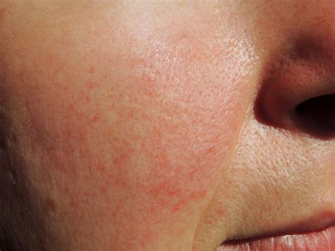 How To Get Rid Of Skin Conditions That Arent Acne Business Insider