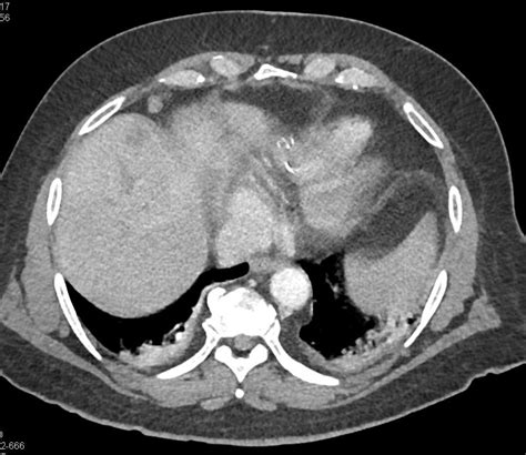 Gallbladder Cancer With Liver Metastases Liver Case Studies Ctisus