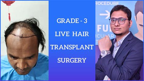 Grade 3 Live Hair Transplant Surgery 2000 Grafts In India FUE INDIA