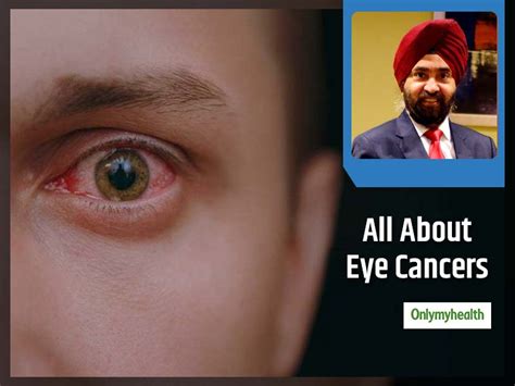 Types Stages And Basic Treatment For Eye Cancers Explained By Dr Mahipal Singh Sachdev