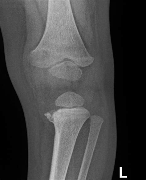 Proximal Tibial Fractures 2023