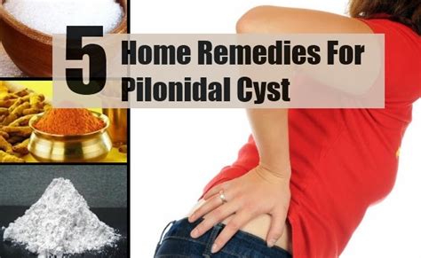 5 Simple Home Remedies For Pilonidal Cyst ~ Mzizi Mkavu