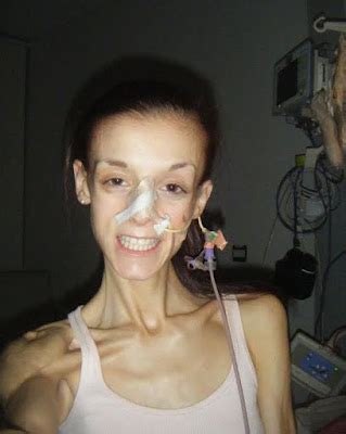 Shocking Photos Of Anorexic Woman Who Did Sit Ups A Day And Ate