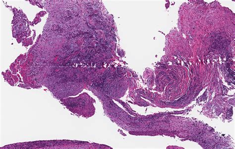 Pathology Outlines Inflammatory Collateral Cyst