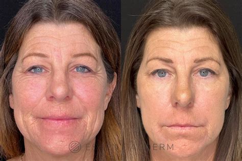 Chemical Peels Before And After Pictures Case 48 Natick Ma