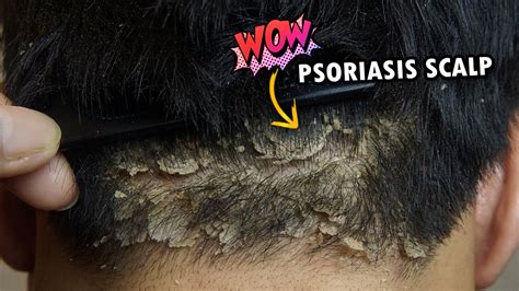 Wow Psoriasis Dry Scalp Scratching So Much Dandruff Removal