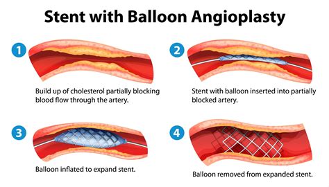Populer 43 Balloon Angioplasty