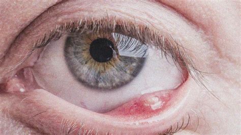 Eyelid Pimple Inside