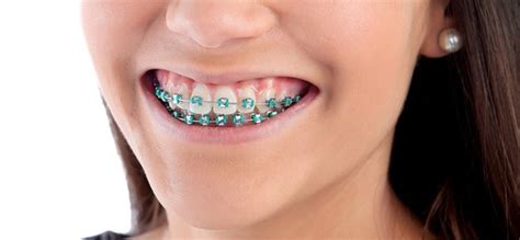 27 Ideas Geniales Para Combinar Colores De Brackets Todosobrecolores