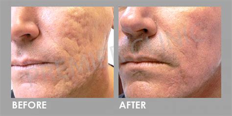 Subcision Treatment For Acne Scars And Cellulite