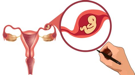 Aumento Uterino Homogêneo Inespecífico Pode Ser Gravidez