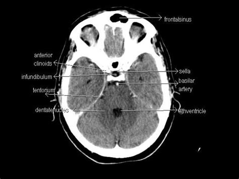 Ct Scan Brain Anatomy Anatomy Of Head Ct Scan Normal The Brain On Ct