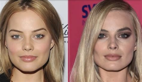 Many plastic surgeons offer patient financing plans for buccal fat removal surgery, so be sure to ask. Am I Too Young for Buccal Fat Removal? - Rival Cosmetic