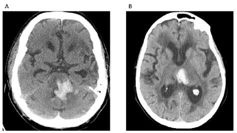 Intracerebral Hemorrhage Due To Arterial Hypertension A