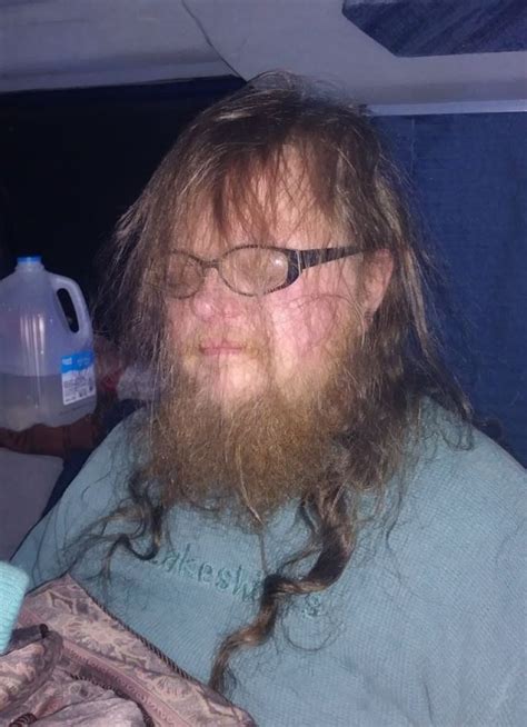 Rare Condition Makes Woman Grow Huge Beard And Get Mistaken For A Man