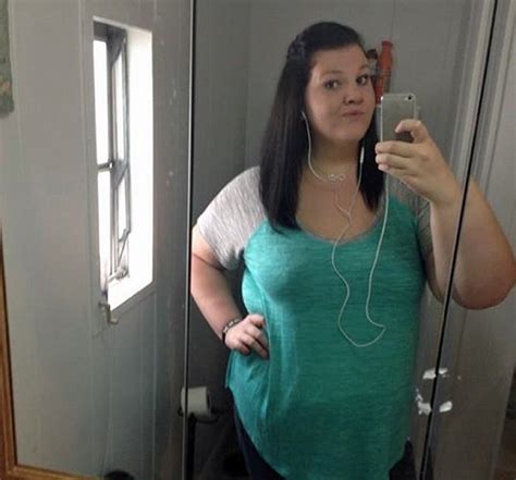 Obese Woman Who Gorged On 11000 A Day Loses 17st After Having Gastric