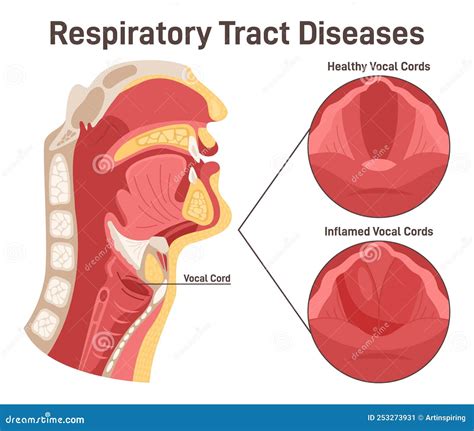 Upper Respiratory Tract Disease Laryngitis Inflammation Of The Vocal