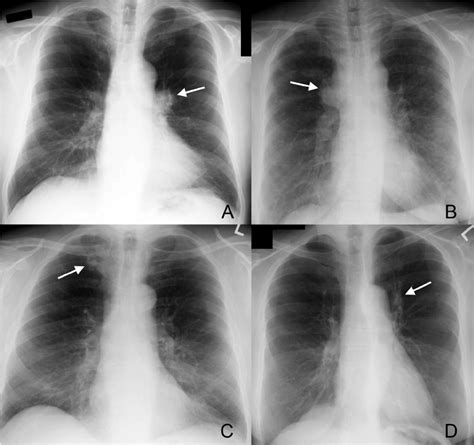 Examples Of Findings On Second Review Of Screening Chest X Rays A
