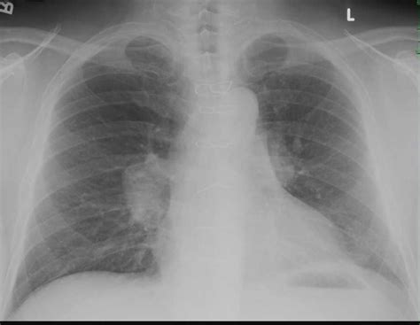 Normal Hands On X Ray X Rays Case Studies Ctisus Ct S