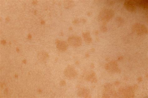 Top Natural Home Remedies For Tinea Versicolor Health Blog