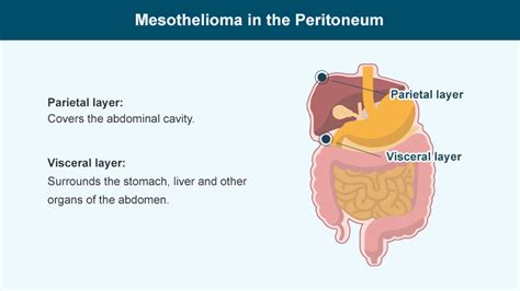About 600 cases are diagnosed each year in the united. Peritoneal Mesothelioma: Causes, Treatment & Survival Rates