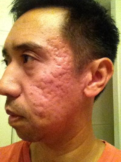 Cystic Acne Scarring Shitty Advice