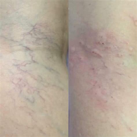 Esteticista Pode Fazer Secagem De Vasinhos