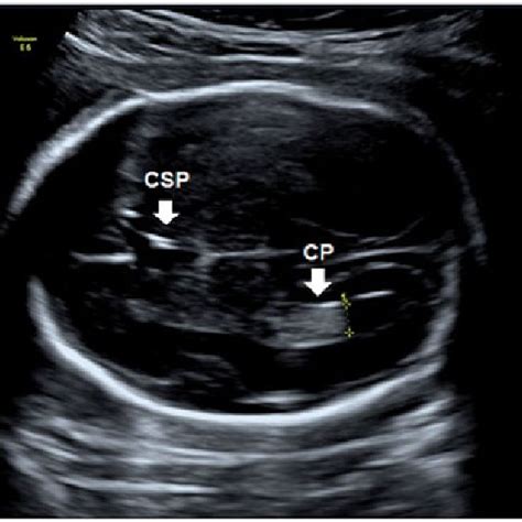 Pdf Reference Values For The Fetal Lateral Ventricle Atrium