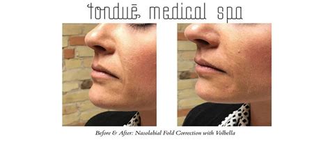 Before And After Photos Of Nasolabial Fold Correction With Volbella At