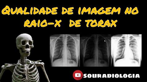 Qualidade T Cnica Em Um Raio X De T Rax No Sistema Dr Radiologia Youtube