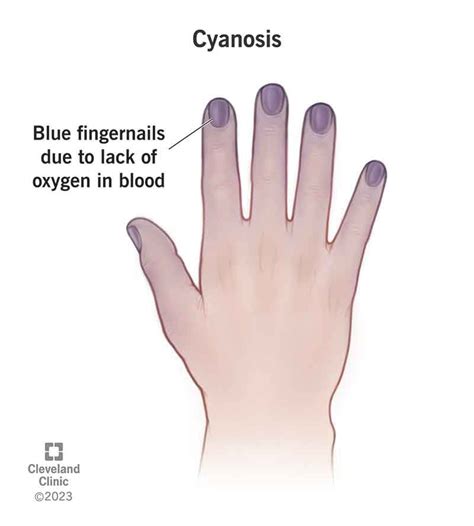 Cyanosis Blue Hands And Feet Causes Treatment And Diagnosis