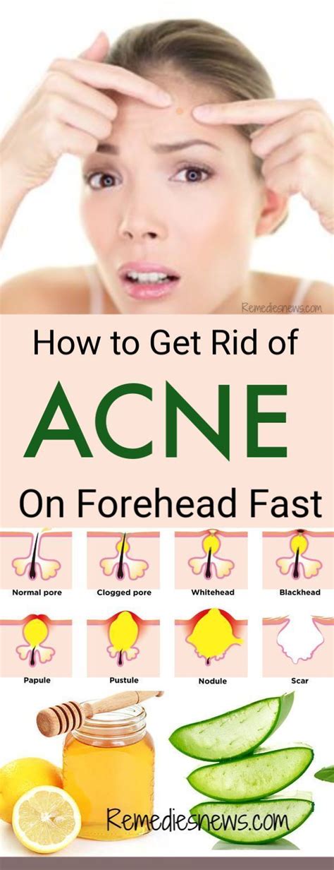 Pin On But Acne Remedies