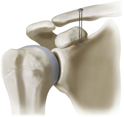A Right Shoulder Acromioclavicular Joint Dislocation Treated With A