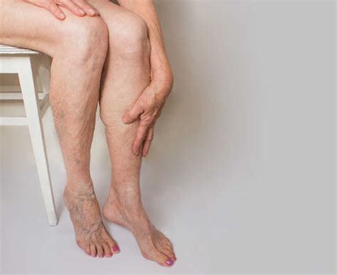 Your Guide To Varicose Veins In The Feet Cvr Blog