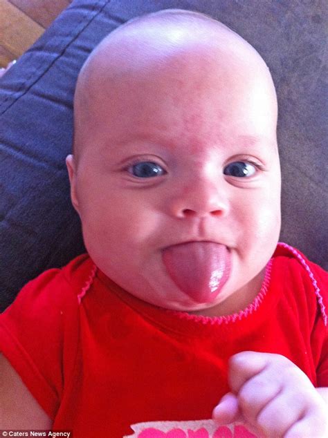 Baby Girl Born With Her TONGUE Constantly Poking Out Undergoes Surgery