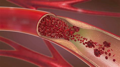 What Causes Plaque In The Arteries