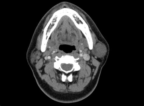 Benign Mixed Salivary Tumor Of The Parotid Gland Image
