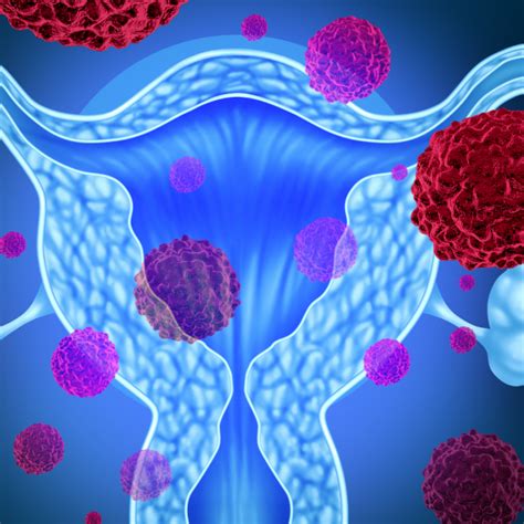 Here, we discuss the signs and symptoms you should watch out for and discuss with your dr. Womb cancer | Irish Cancer Society
