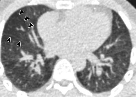 Normal Range Of Emphysema And Air Trapping On Ct In Young Men Ajr