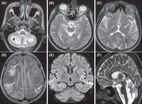 Brain Mri Of A 21‐year‐old Boy With Ctx Ac Bilateral Cerebellar