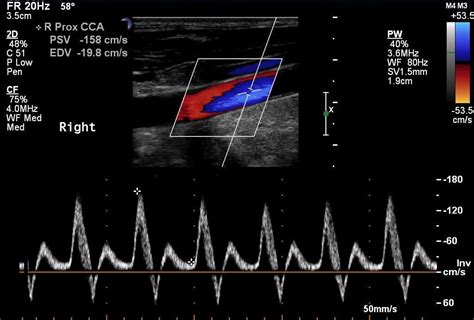 Color Doppler Flow The Flow Reversal Is Marked In This Image The
