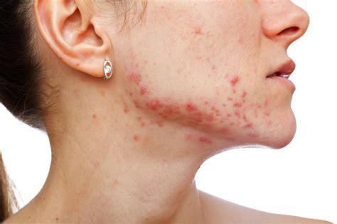 How To Get Rid Of Red Spots On Face Causes Types And