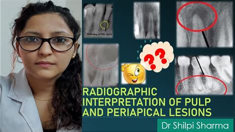 Radiographic Interpretation Of Pulp And Periapical Infections